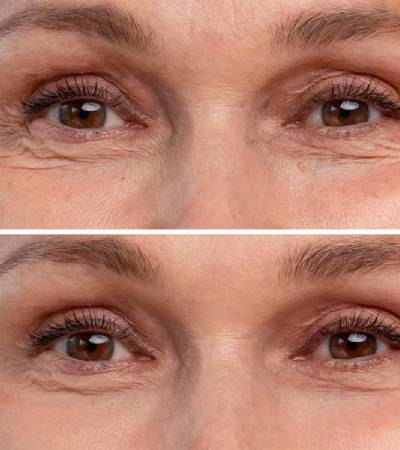 Crows feet correction